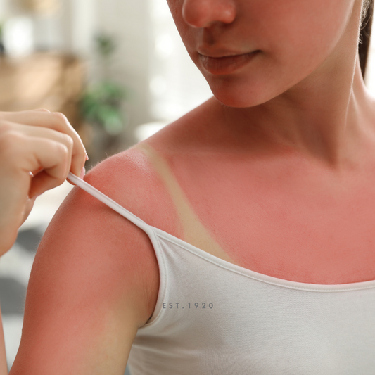 5 Tips for Dealing with a Sunburn