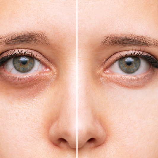 essential oils for dark eye circles