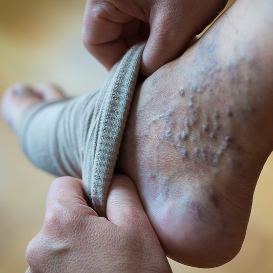 Understanding the Causes of Purple Veins