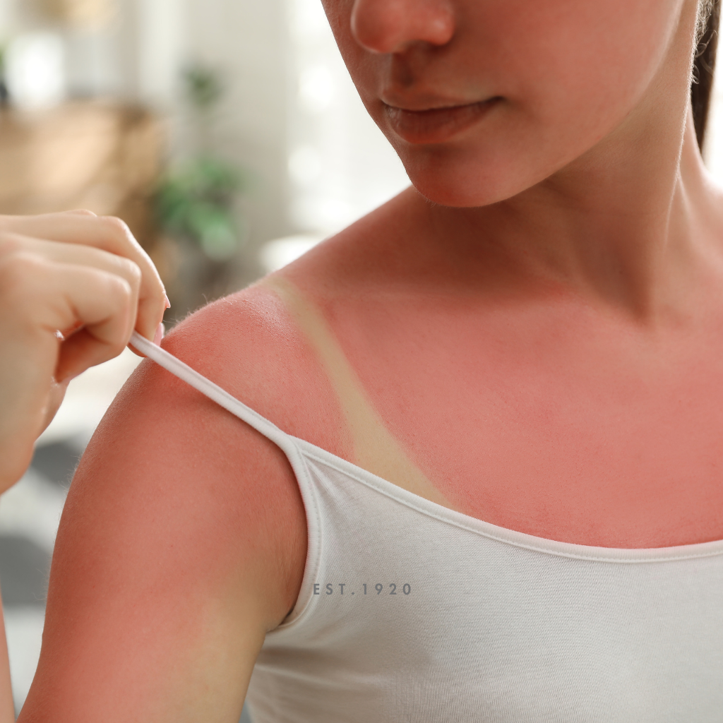 5 Tips for Dealing with a Sunburn